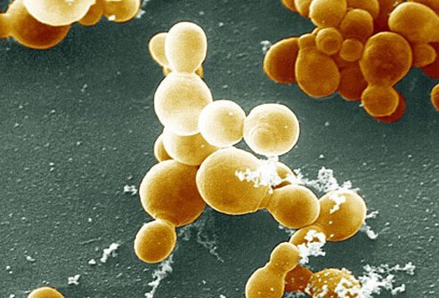 Seborrheic Dermatitis Seborrheic Dermatitis