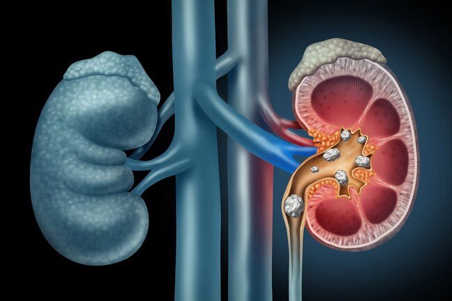 Salt, ammonia, or cystine associated with kidney stones may cause urine odor.