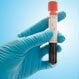 Alpha Thalassemia