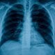 Alpha-1 Antitrypsin Deficiency