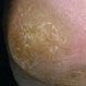 Corns and Calluses