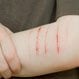 Cuts, Scrapes, and Puncture Wounds