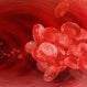 Hodgkin's Disease
