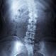 What Is Scoliosis?