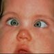 Strabismus (Crossed Eyes)
