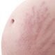 What Are Stretch Marks?