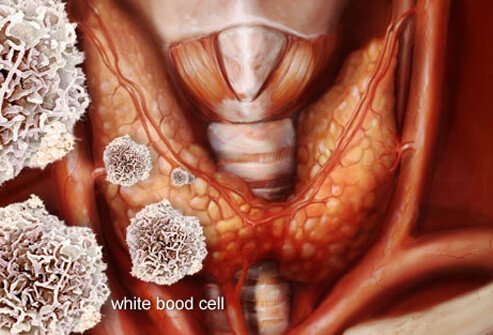 Hashimoto's disease, an autoimmune condition, is the most common cause of hypothyroidism.