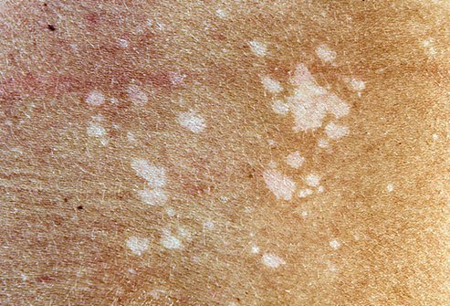 Hypopigmentation is a condition in which the skin is lighter in color than normal. Treating hypopigmentation may involve the use of topical corticosteroids or tars, light or laser treatment, or surgical skin grafting.