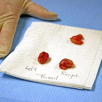 The surgical removal of the tonsils and adenoids is performed during a tonsillectomy and adenoidectomy.