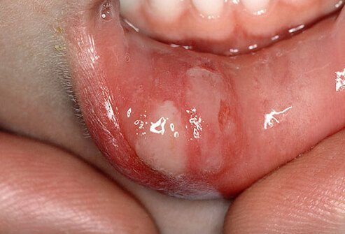 Canker sores can appear nearly anywhere on the flesh of the mouth, including your gums, lips, tongue, and inside your cheek.