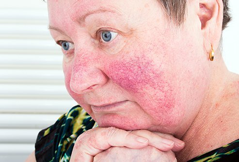 Sun exposure and emotional stress are the most common triggers