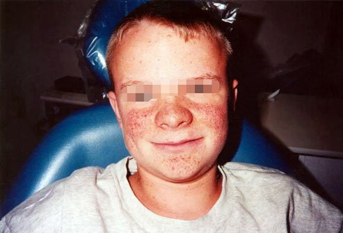 signs and symptoms of tuberous sclerosis
