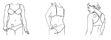 Patch application area - Illustration