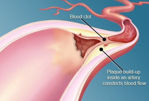 Around two out of every three people with diabetes die of heart disease.