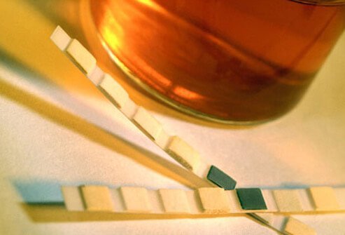 The risk for developing chronic kidney disease increases with time in people with diabetes.