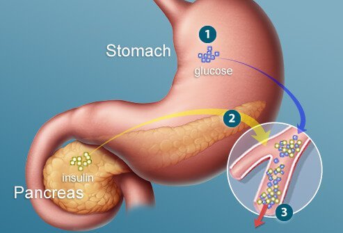 Insulin is a hormone that allows the body to efficiently use glucose as fuel.