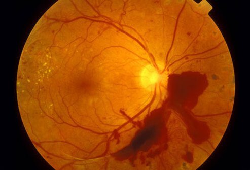 Diabetic retinopathy is damage to the tiny blood vessels within the retina of the eye due to high blood sugar levels over time.