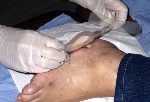 Damage to nerves caused by diabetes can make it hard to feel injuries to the feet.