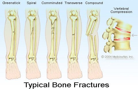 Bone Fractures Illustration - Open fracture