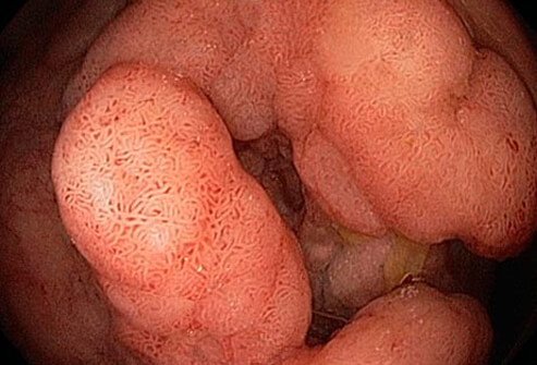 Individuals with ulcerative colitis are at increased risk for colon cancer.