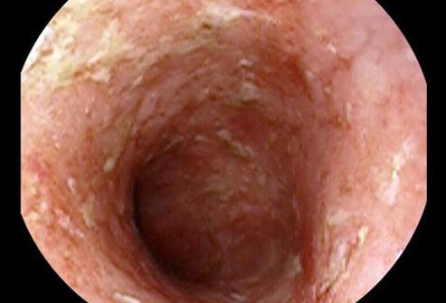 The main symptoms caused by ulcerative colitis are abdominal pain and diarrhea, usually bloody.