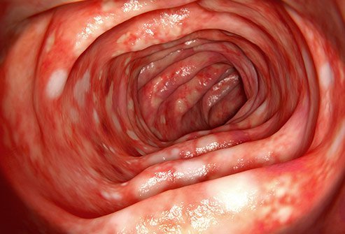 ulcerative colitis (UC)