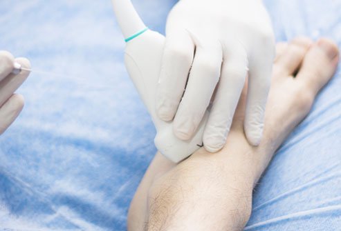 A sural nerve block is a procedure for anesthetizing a part of the calf, lower leg, heel and foot. An anesthetic solution is injected adjacent to the Achilles tendon on the outer side of the foot. The anesthetic blocks the transmission of pain signals from injury or surgery in these parts of the lower leg.