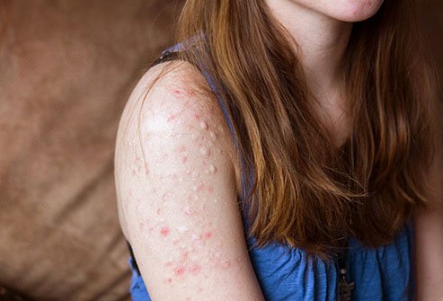 Picking your skin is a sign of dermatillomania. 