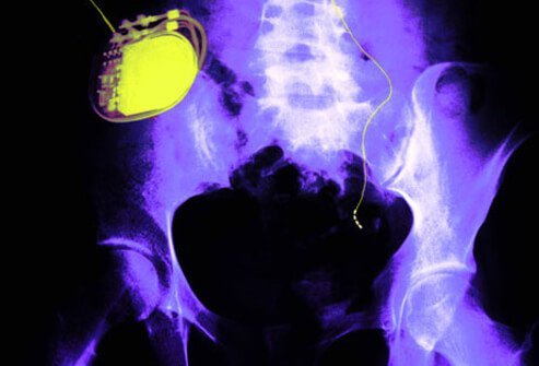 Men with stress urinary incontinence may benefit from surgery.