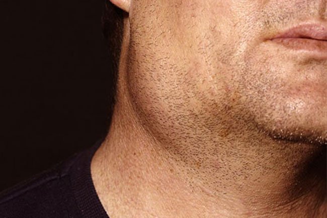 Mumps causes swollen salivary glands and may be associated with complications like meningitis and swelling of the testicles and ovaries. 