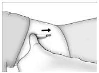 Removing the Implant - Illustration 2