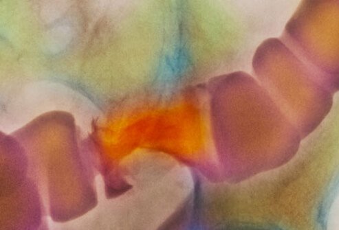 Although to a large extent replaced by endoscopy, barium X-ray studies still are used for the diagnosis of IBD.