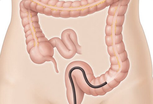 Endoscopy is the best method for diagnosing IBD.
