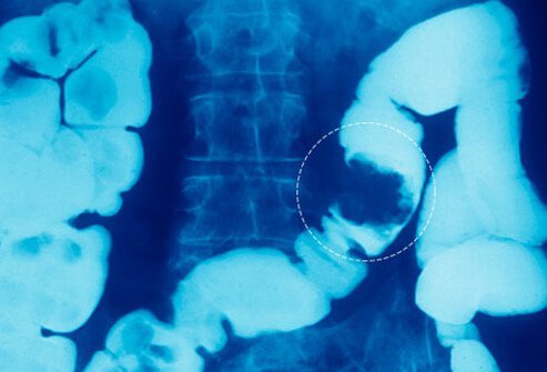 The inflammation of Crohn's disease involves the full thickness of the bowel wall.