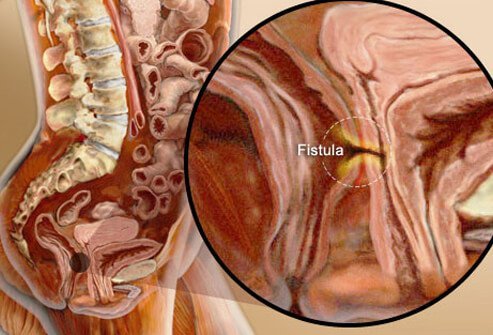 Fistulas and abscesses usually are treated surgically.