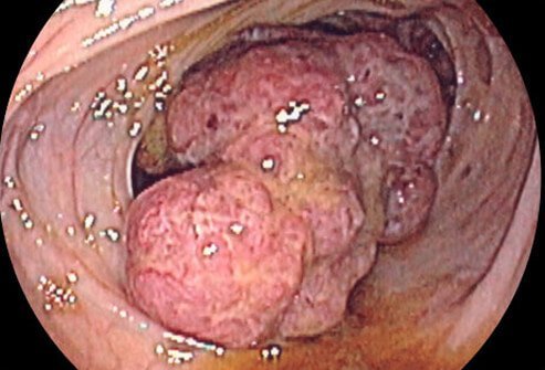 Cancer of the bowel is a later complication of IBD.