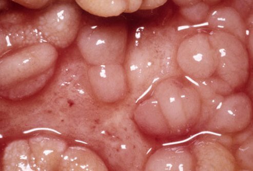In Crohn's disease, inflammation involves the entire wall of the bowel, even the deeper portions.
