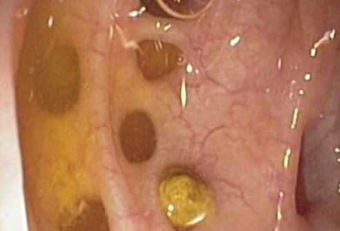 Other common abdominal diseases that can mimic IBD are diverticulitis, celiac disease, and colon cancer.