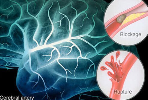 When the brain's blood supply is inadequate, a stroke results.