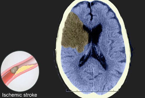 This slide shows a CT scan of an ischemic stroke, which is responsible for about 80% to 90% of all strokes.