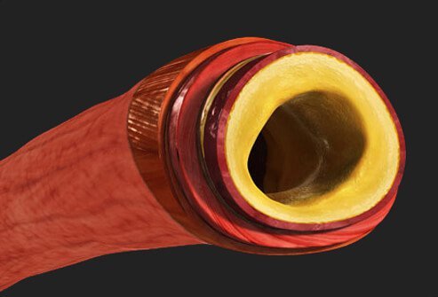 Common causes of stroke come from blood vessels both outside and inside the brain.