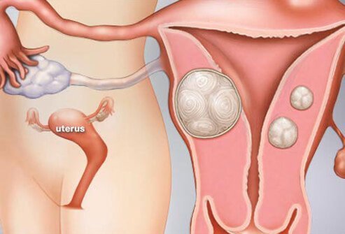 Uterine fibroids are noncancerous tumors that grow along or within the walls of the uterus. 