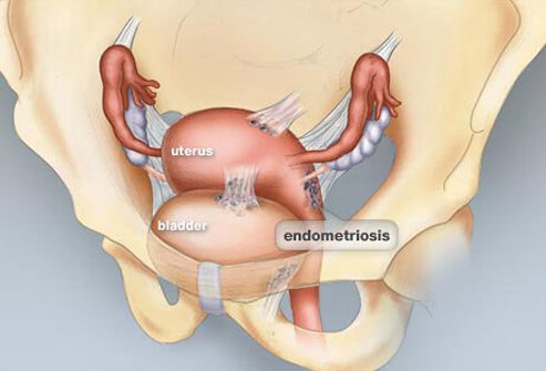 What's the difference between endometriosis and fibroid symptoms?