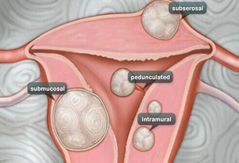 We present information on the various types of uterine fibroids.