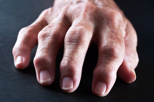 Cat's claw boosts immunity and it may also help ease swelling and pain in those with RA.