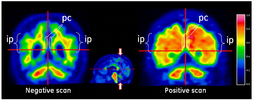 Sagittal view of
negative (left) and positive (right) Vizamyl scans - Illustration