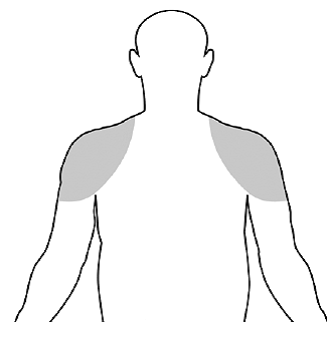 Application sites for Vogelxo are the shoulders and
the upper arms that will be covered by a short sleeve t-shirt  - Illustration