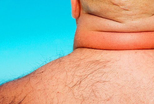 Cushing's syndrome is a condition characterized by elevated levels of the hormone cortisol.