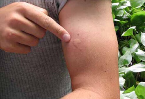 West Nile virus is not contagious and cannot be transmitted from person to person.