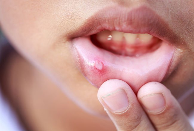 Mouth blisters are sores on the lips, cheeks, tongue, or areas inside or around the mouth. Thye can be caused by dental work, an accidental bite from eatng, irritation or injury, viral infections, or cancer of the mouth.
